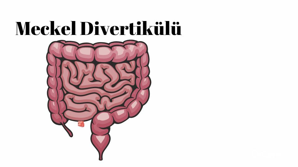 Meckel divertikülü görseli - DrCem hastalık rehberi